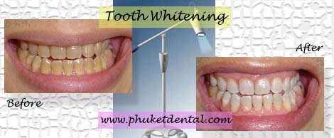 Tooth Whitening:Coldlight,non-LASER,LED,Natural Plus at Phuket Dental Clinic,Thailand